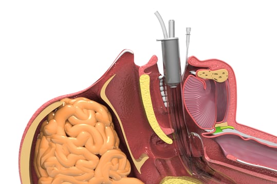 intubation